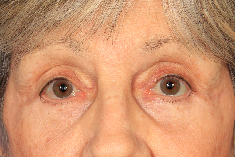 Blepharoplasty Before & After Photo