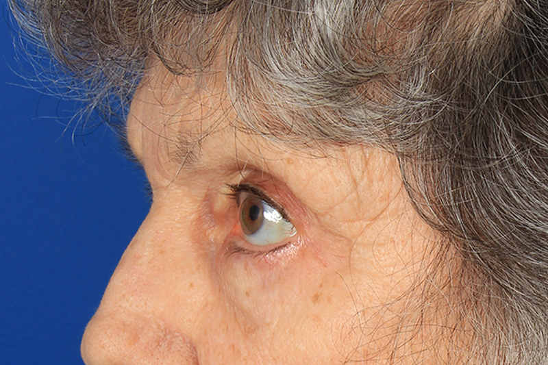 Blepharoplasty Before & After Photo