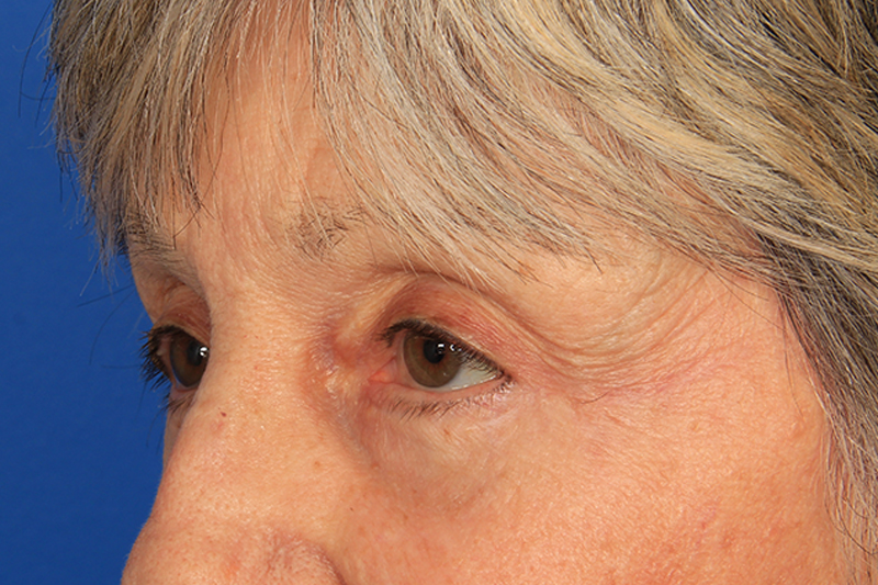 Blepharoplasty Before & After Photo