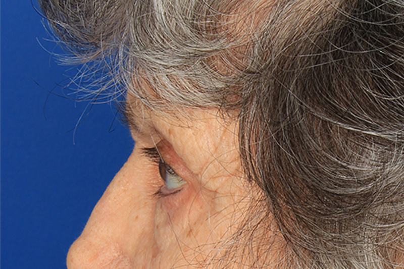 Blepharoplasty Before & After Photo