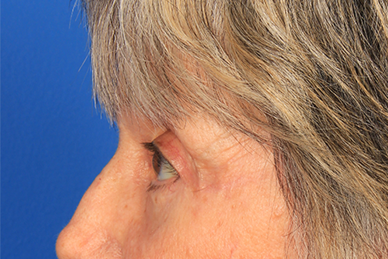 Blepharoplasty Before & After Photo