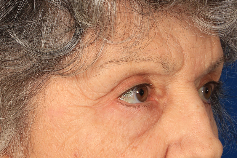 Blepharoplasty Before & After Photo