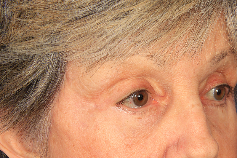 Blepharoplasty Before & After Photo