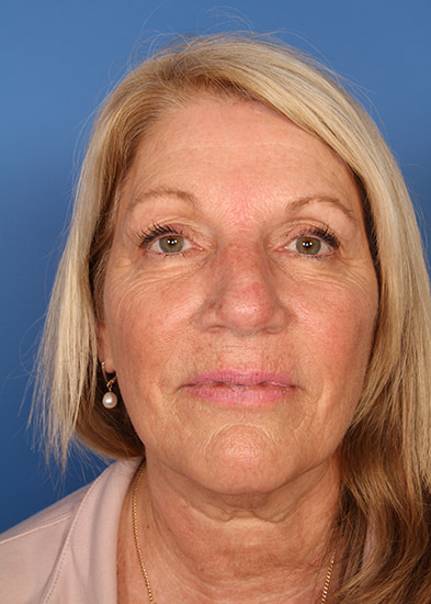 Blepharoplasty Before & After Photo