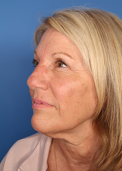 Blepharoplasty Before & After Photo