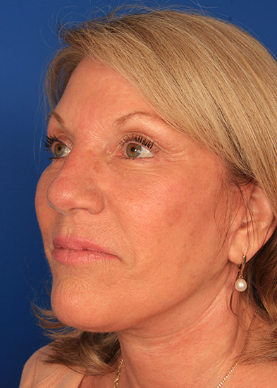 Blepharoplasty Before & After Photo