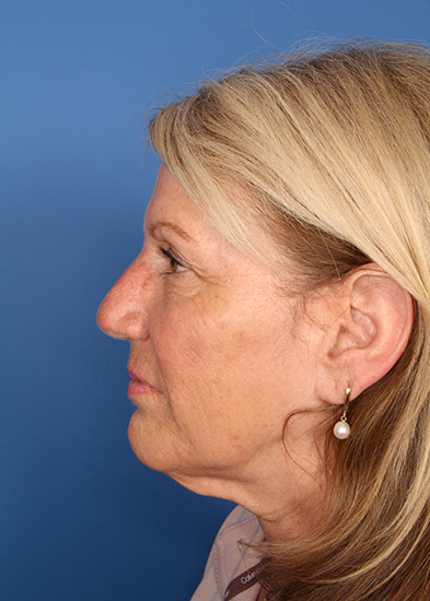 Blepharoplasty Before & After Photo