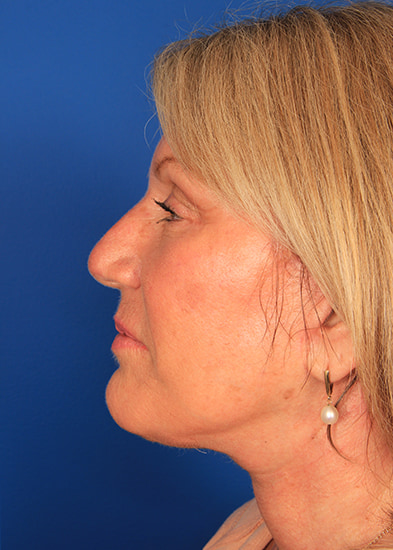 Blepharoplasty Before & After Photo