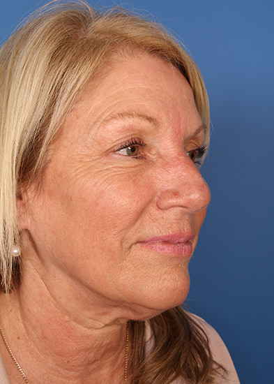 Blepharoplasty Before & After Photo