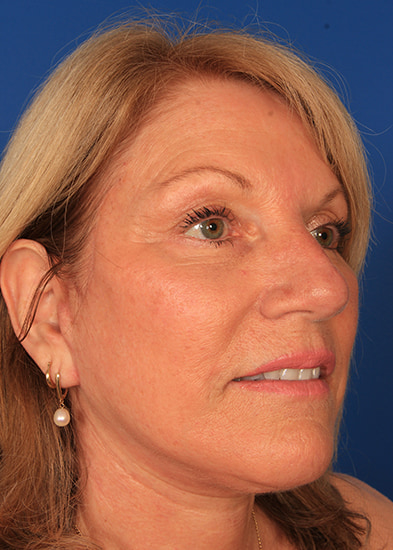 Blepharoplasty Before & After Photo