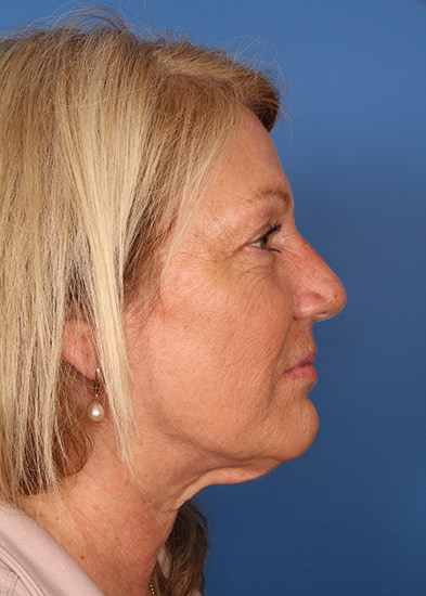 Blepharoplasty Before & After Photo