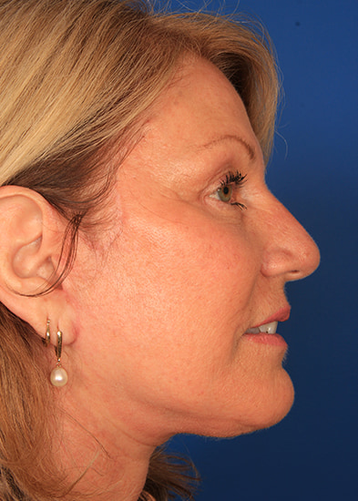 Blepharoplasty Before & After Photo