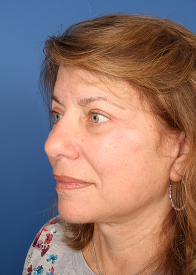 Blepharoplasty Before & After Photo