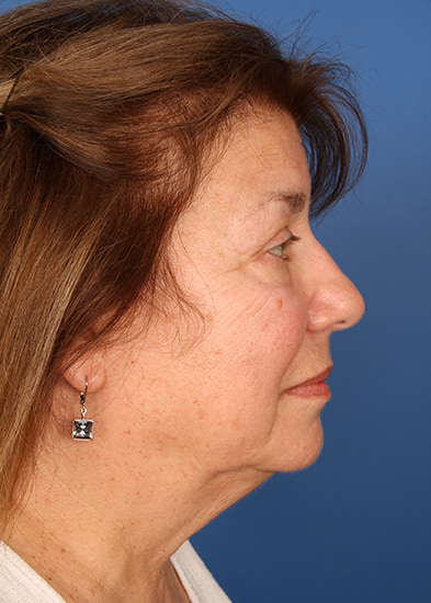 Blepharoplasty Before & After Photo