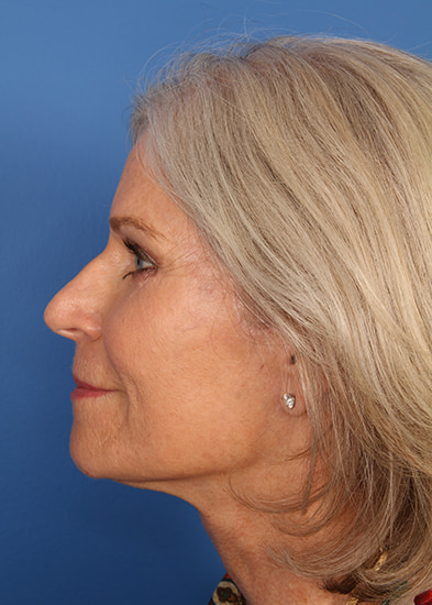 Blepharoplasty Before & After Photo