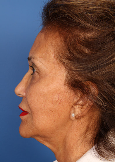 Blepharoplasty Before & After Photo