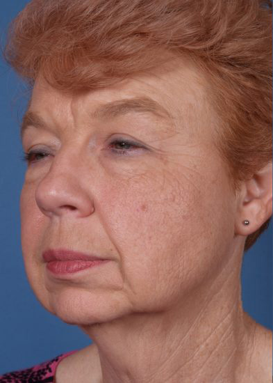 Blepharoplasty Before & After Photo