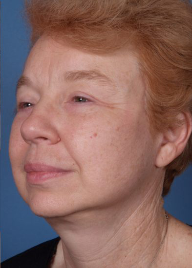 Blepharoplasty Before & After Photo