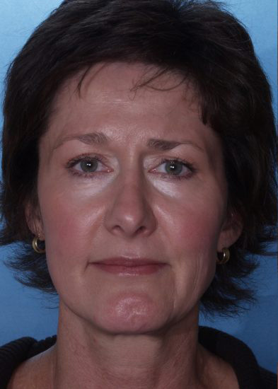 Blepharoplasty Before & After Photo