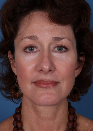 Blepharoplasty Before & After Photo