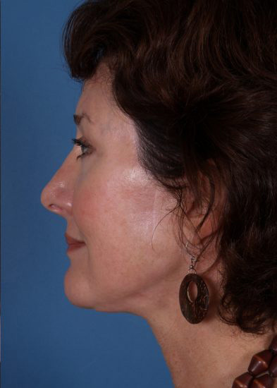 Blepharoplasty Before & After Photo