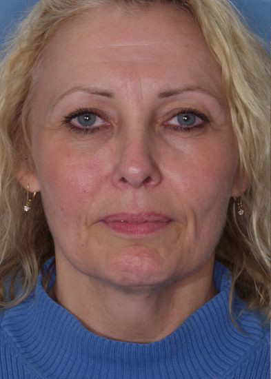 Blepharoplasty Before & After Photo