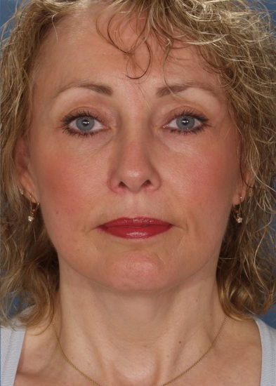 Blepharoplasty Before & After Photo