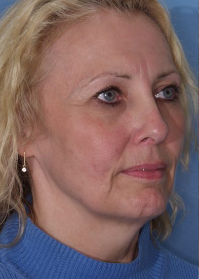 Blepharoplasty Before & After Photo