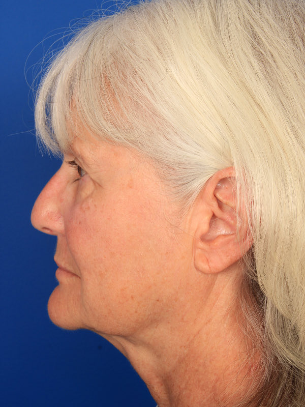 Browlift Before & After Photo