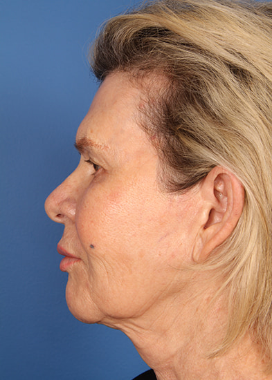 Browlift Before & After Photo