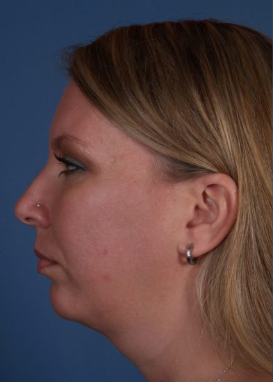 Chin Implant Before & After Photo