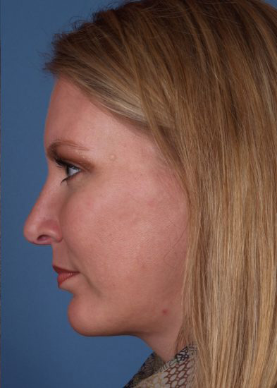 Chin Implant Before & After Photo