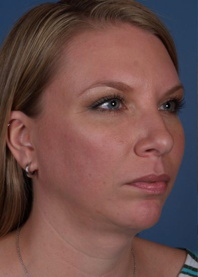 Chin Implant Before & After Photo