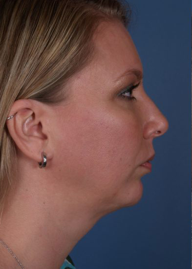 Chin Implant Before & After Photo