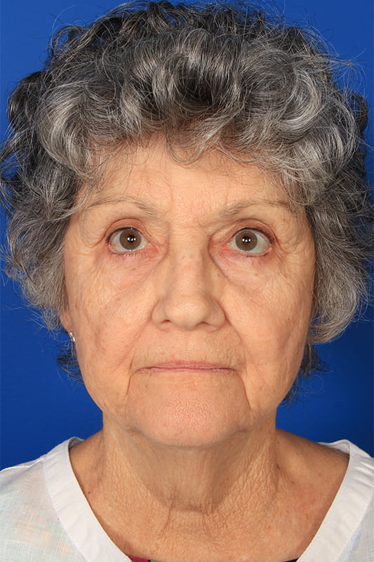 Facelift Before & After Photo