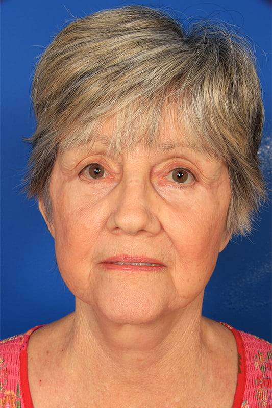 Facelift Before & After Photo