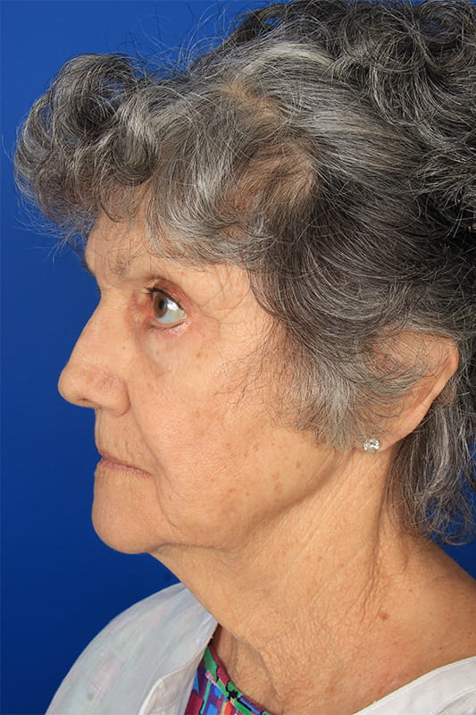 Facelift Before & After Photo