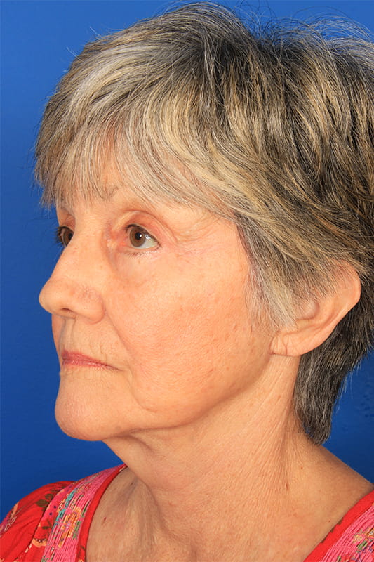 Facelift Before & After Photo