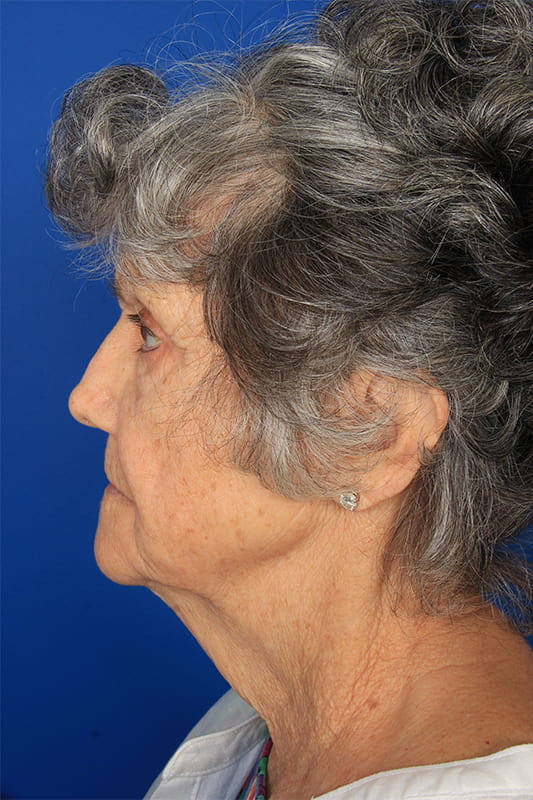 Facelift Before & After Photo