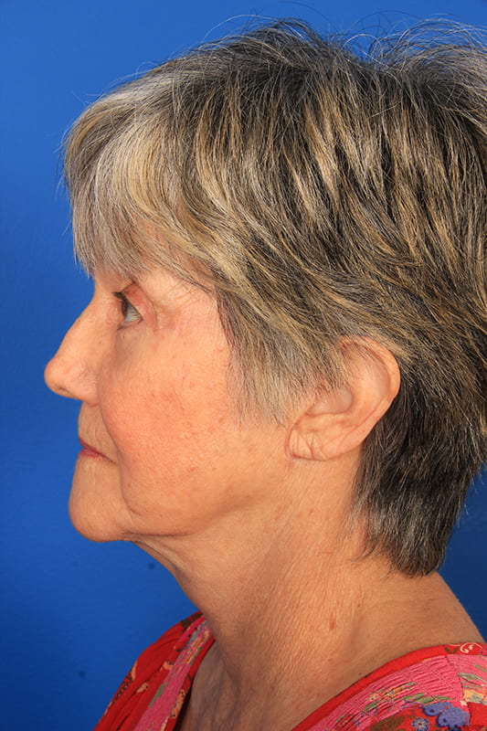 Facelift Before & After Photo