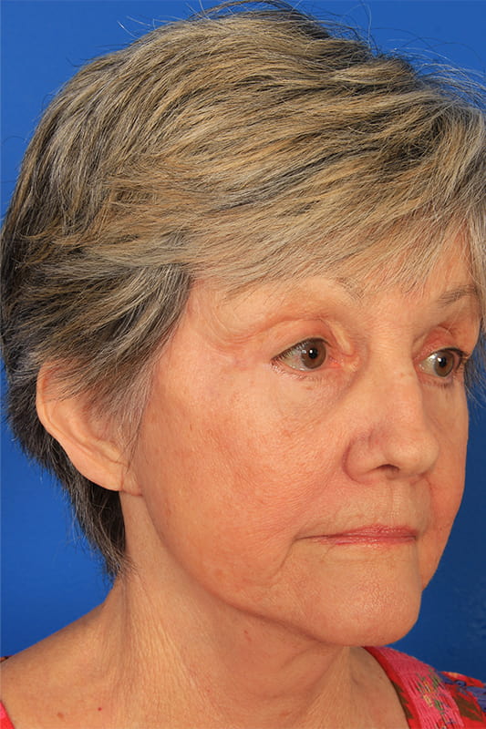 Facelift Before & After Photo