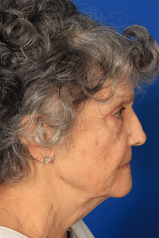 Facelift Before & After Photo