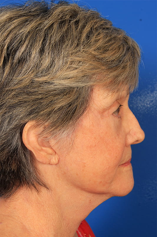 Facelift Before & After Photo