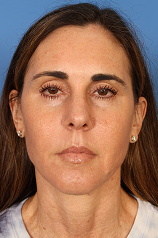 Facelift Before & After Photo