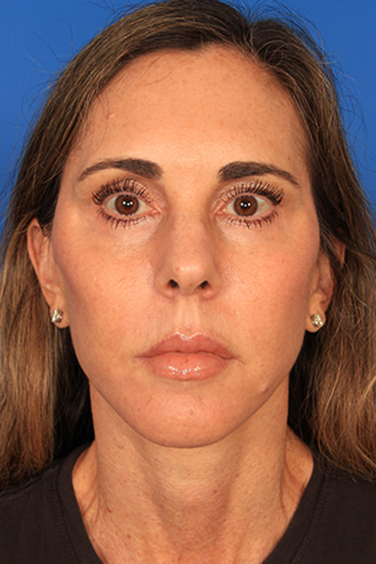 Facelift Before & After Photo