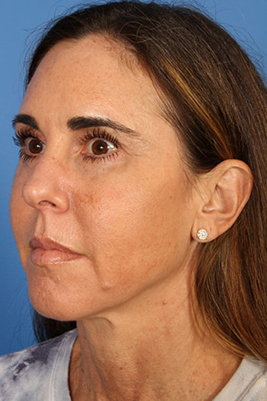 Facelift Before & After Photo