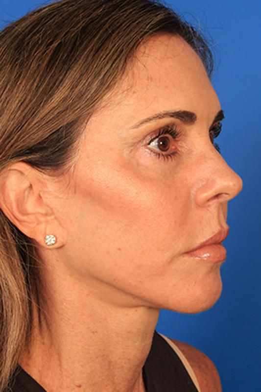 Facelift Before & After Photo