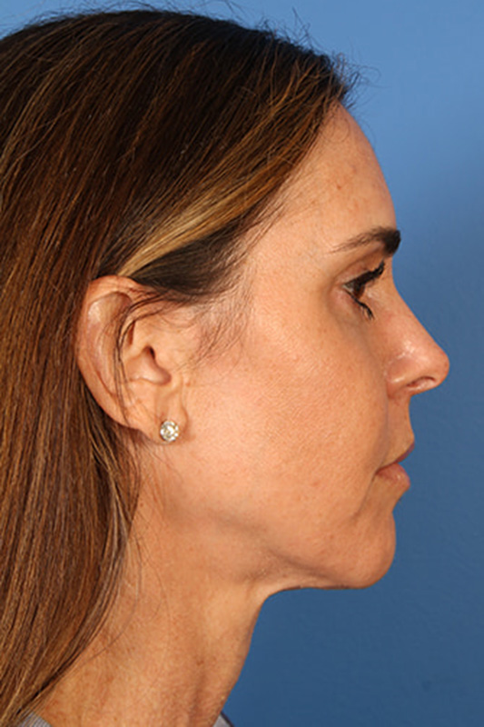 Facelift Before & After Photo