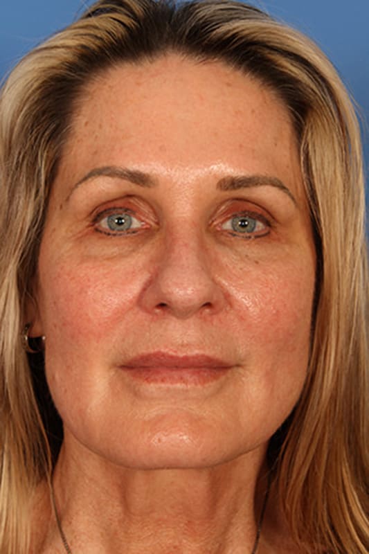 Facelift Before & After Photo