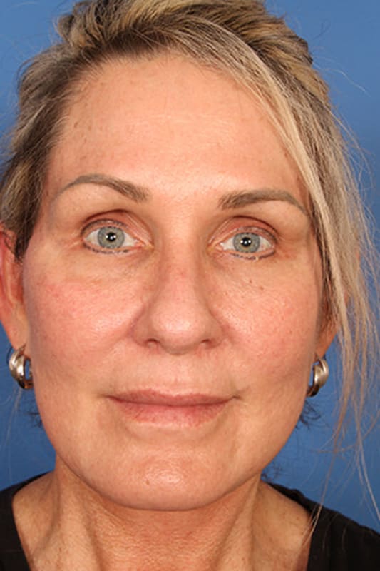 Facelift Before & After Photo